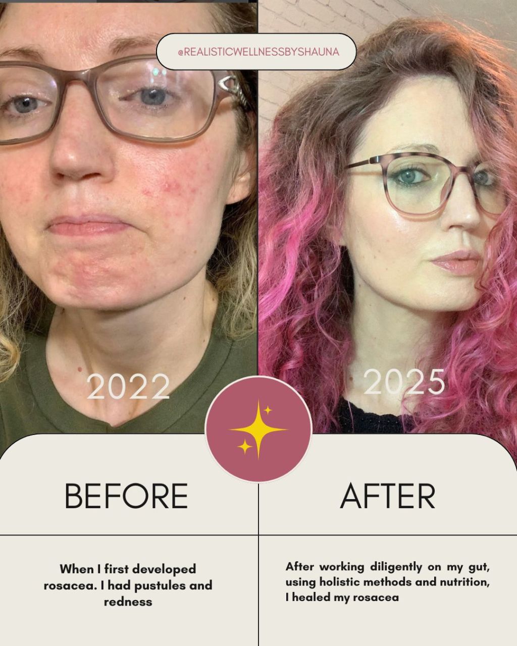 What causes rosacea? Hidden Triggers & How To Tackle&nbsp;It